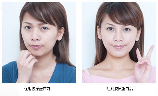 胶原蛋白效果图