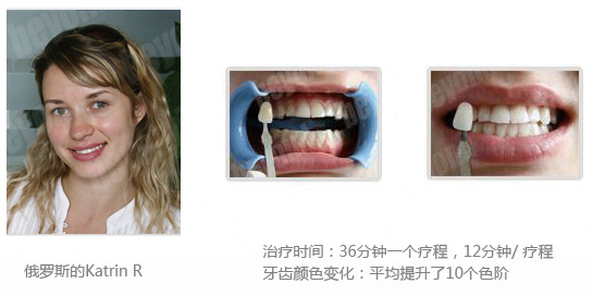 牙齿美白