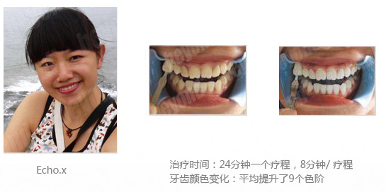 美国BEYOND冷光美白